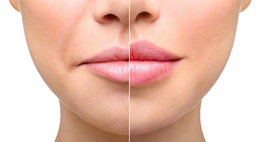 Vergleich des Gesichts einer Frau vor und nach der Behandlung mit Dermal Fillern, mit verbessertem Lippenvolumen und reduzierten Falten.