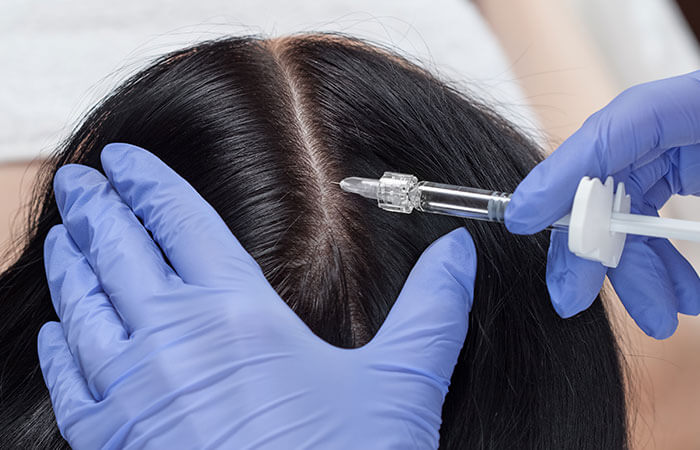 Ein Profi, der eine Haarfüller-Behandlung auf der Kopfhaut einer Frau durchführt und sich auf den Bereich entlang des Scheitels konzentriert, um die Haardichte zu erhöhen.